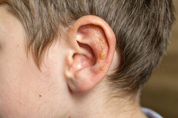 Child's ear with skin blister condition. Medical dermatology issue