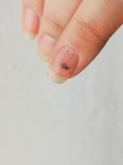 Subcutaneous hematoma on the finger. A bruise on my leg. Treatment of minor bruises. 