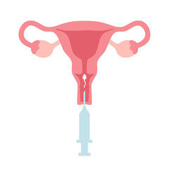 Intrauterine insemination infographic. IUI. Uterus and syringe with sperm illustration in cartoon flat style