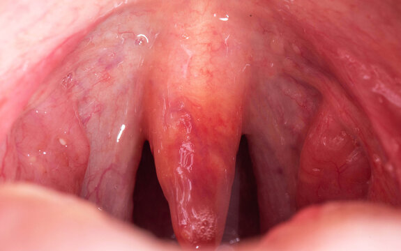 Red, inflamed and swollen uvula in the throat. Treatment of uvulitis due to bacteria and streptococcal viruses. Otolaryngology, macro. Allergy