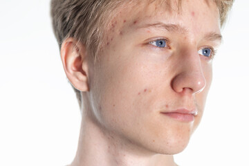 Obraz premium Close-up of Teenager's Skin with acne