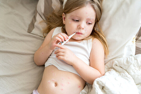 Fever, viral disease in a child. Girl lying in bed with chickenpox rash with thermometer