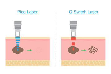 Compare the effect of Pico laser and Q switch laser on area skin layer. Laser treatment dark spot, Melasma, and scar.