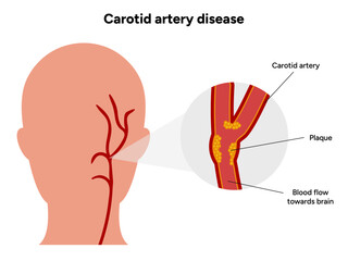 Carotid artery disease Signs of Carotid Artery Disease medical illustration diagram