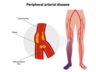 Peripheral Arterial Disease Daily Life and Mobility medical illustration 