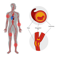 Carotid artery disease Signs of Carotid Artery Disease medical illustration diagram