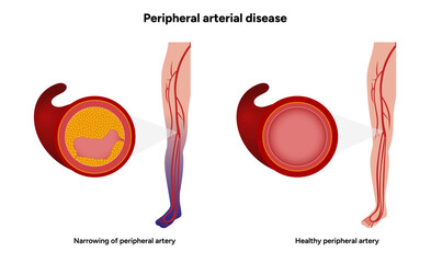 Peripheral Arterial Disease Daily Life and Mobility medical illustration 