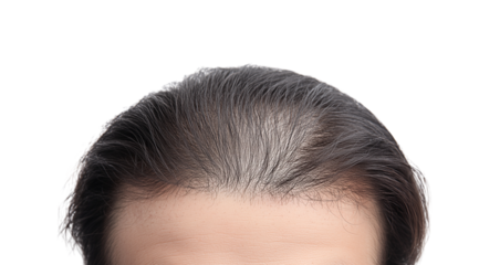 PNG, Hair loss concept, man with alopecia, isolated on white background, generated by Generative AI technology.