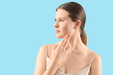 Teenage girl with acne problem on blue background, closeup