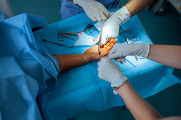 Doctors Performing Hand Surgery in orthopedics Clinic. Medical personnel using a retractor for...