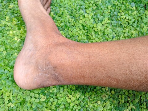 Close-up of a type 2 diabetic's feet with dry, cracked skin and visible veins. The skin appears discolored and unhealthy, highlighting the potential complications of diabetes.