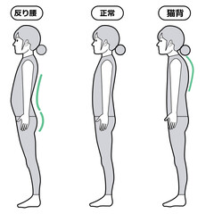 反り腰と猫背の状態