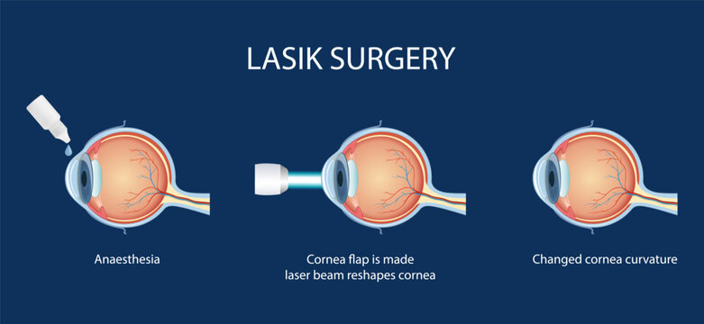 The process of laser eye surgery LASIK. Vision correction for nearsightedness, farsightedness, and astigmatism