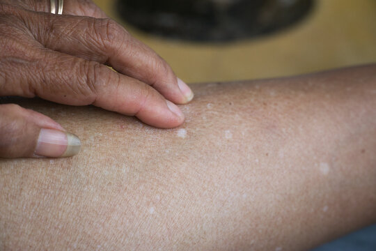 Idiopathic guttate hypomelanosis (IGH) is a common, harmless skin condition that causes small, flat, white spots on the skin. It's usually found on the arms, legs, and face of older people