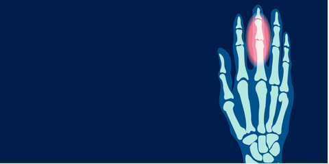 X-ray image of hand finger pain illustration. 2D illustration picture rontgen of finger bone. Vector design.