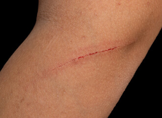 Fototapeta premium A person's arm has a red line on it