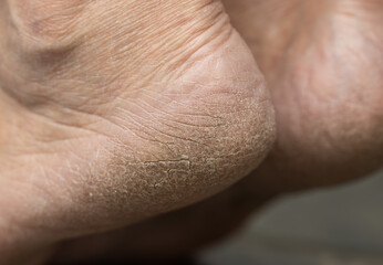 Naklejka premium A person's feet with dry, cracked skin