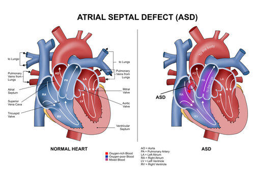 Atrial Septal Defect (ASD) Illustration