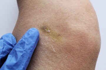 Fototapeta premium A doctor in blue gloves makes cream treatment on bruised leg as result of sport trauma, accident. Bruise on the leg after domestic violence. Hematology problems. Inflammation skin from hematoma