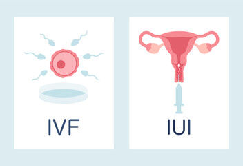 In vitro fertilization IVF and intrauterine insemination IUI infographic posters set. Egg, sperm, uterus and syringe illustration in cartoon flat style