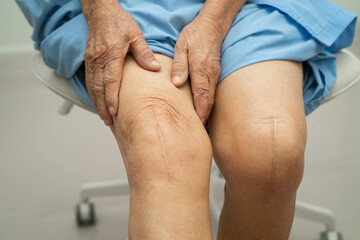 Asian elderly woman patient with scar knee replacement surgery in hospital.