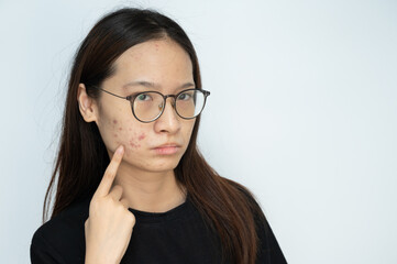 Young Asian woman pointing to acne problems on her face. Inflamed acne consists of swelling,...