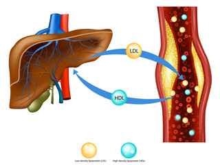 Cholesterol Transport: LDL and HDL Explained. Liver and Blood Vessel Cholesterol Metabolism. Lipoproteins and Atherosclerosis. Cholesterol Buildup in Arteries