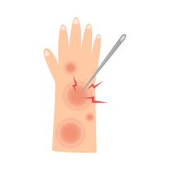 leprosy disease. mycobacterium leprae infection concept