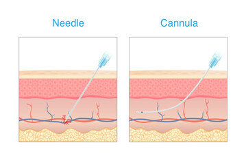 Compare a needle and cannula is equipment of Aesthetic for injecting the skin. Needle punctured blood vessel and lead to a bruise. cannula not penetrating a blood vessel.