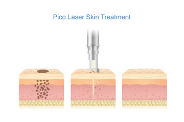 Types of acne scar on facial skin layer. Rolling, Boxed and Icepick scars isolated white background. 3D vector Medical diagram about skin problem from acne.