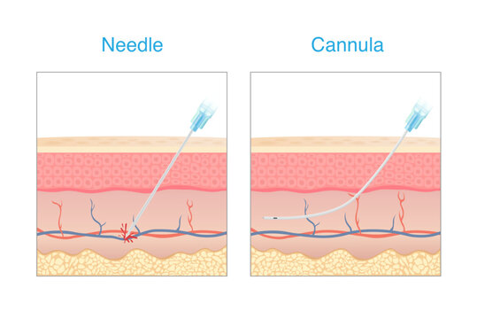 Compare a needle and cannula is equipment of Aesthetic for injecting the skin. Needle punctured blood vessel and lead to a bruise. cannula not penetrating a blood vessel.