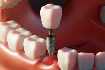 Dental implant screw, placement procedure