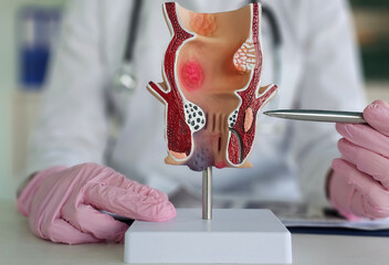 Doctor holds model of unhealthy lower rectum with inflamed vascular structures concept