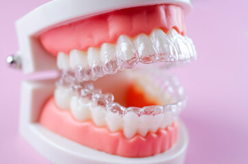 Invisible dental teeth brackets teeth aligners on blue background. Plastic braces dentistry retainers to straighten teeth on a pink background