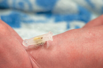 Close-up of a newborn's umbilical cord and belly button with a plastic clamp and antibacterial...