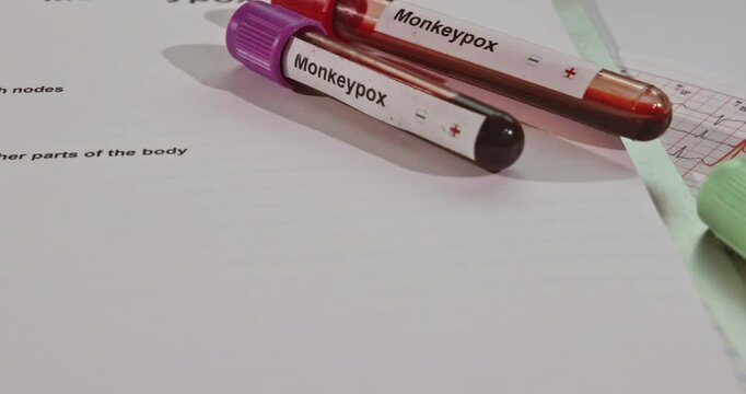 Blood samples are prepared for monkeypox analysis alongside a report showing health metrics and data.