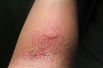 allergic skin bumps on hand