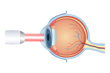 The process of laser eye surgery LASIK. Vision correction for nearsightedness, farsightedness, and astigmatism