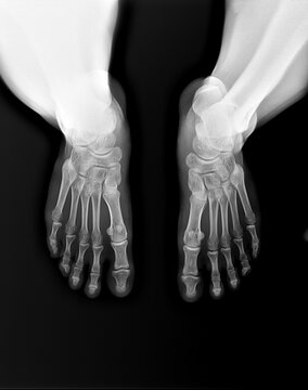 human foot ankel and leg xray picture