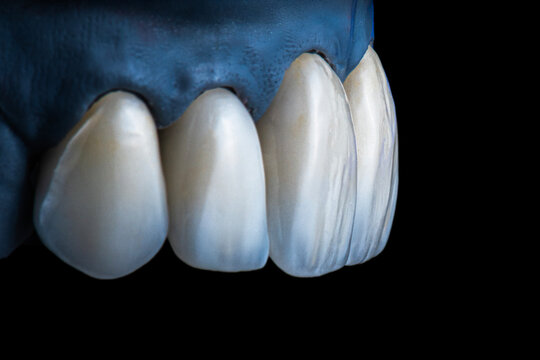 emax crowns and veneers