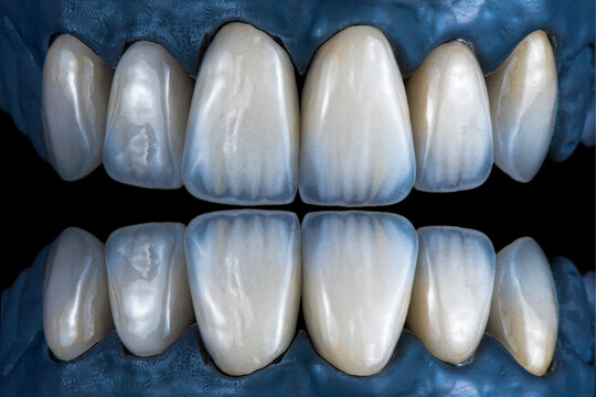 emax crowns and veneers reflex picture