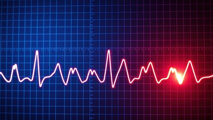 STEMI Heart Attack ECG - Ischemic Heart Disease - Chest Pain