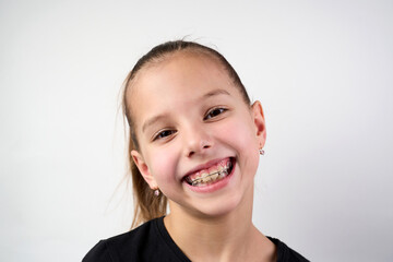 Little girl with teeth retainers looking at camera, close-up. Child with orthodontic plate or dental braces in her mouth. Children's dentistry
