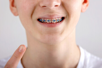Obraz premium Teenage child, boy, wearing brackets, isolated, close portrait