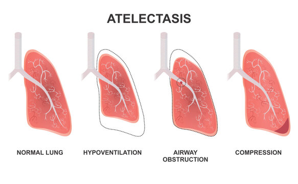 Atelectasis lung diseases illustration types
