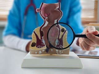Doctor holds magnifying glass and anatomical model of rectum with hemorrhoids concept