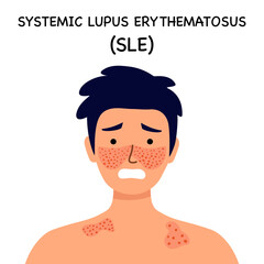 Systemic lupus erythematosus. Guy with the typical butterfly rash in lupus. SLE. skin disease.