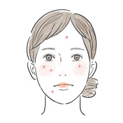 顔にニキビのあるまとめ髪の女性