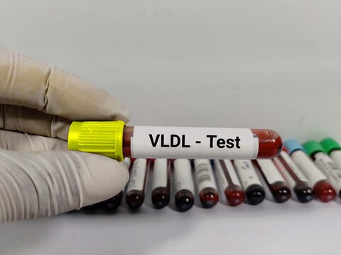 Test Tube with blood sample for Very-low-density lipoprotein (VLDL) test.