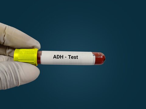 Test Tube with blood sample for ADH (Antidiuretic Hormone) test. Doctor's hand hold blood sample with dark blue background.